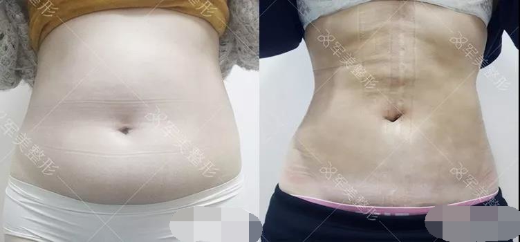 腰腹吸脂