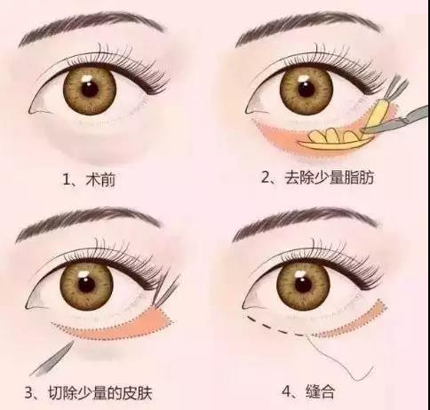 眼袋是怎么形成的