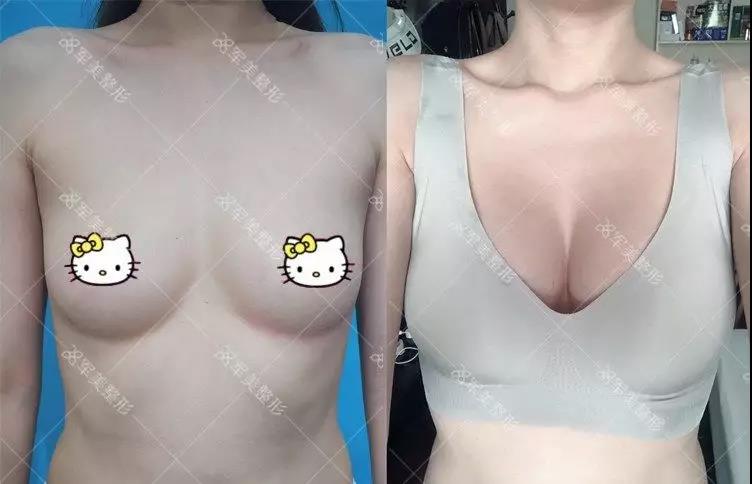 假体隆胸