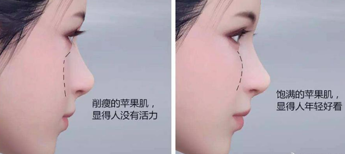 自体脂肪填充面部