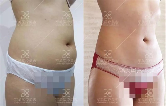 吸脂减肥对身体有害吗