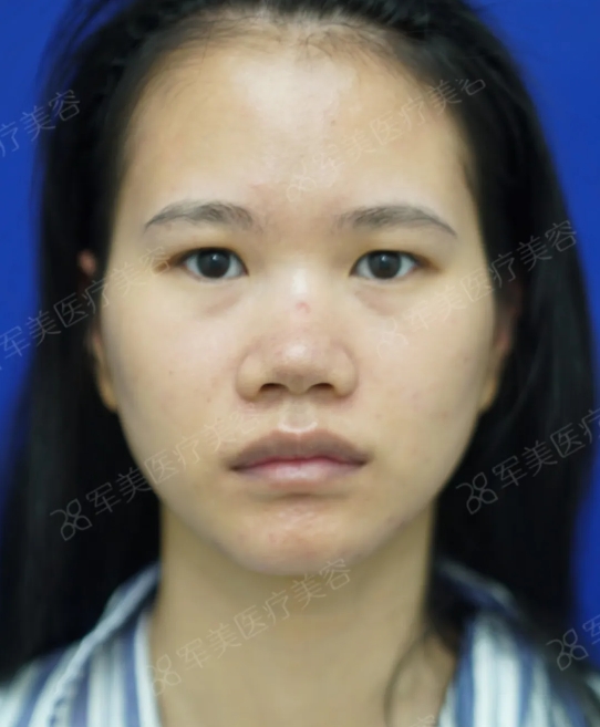 眼鼻综合做完变化大吗