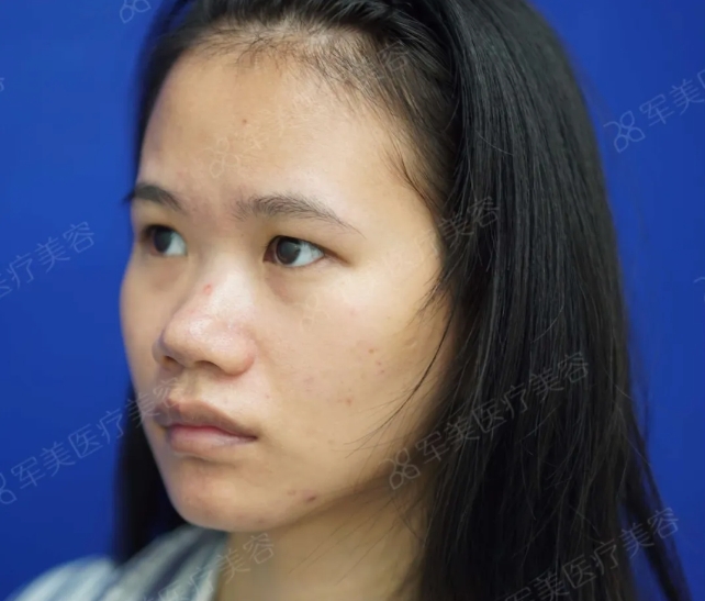 眼鼻综合做完变化大吗