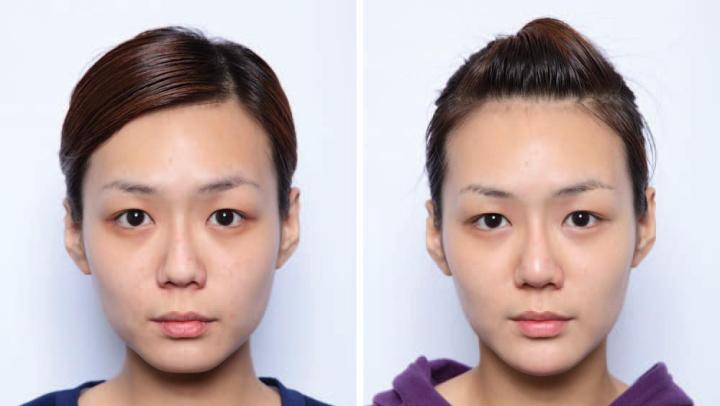 玻尿酸填充面部案例