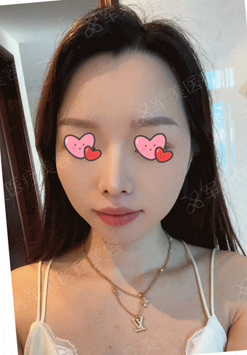 鼻综合前后对比照图片