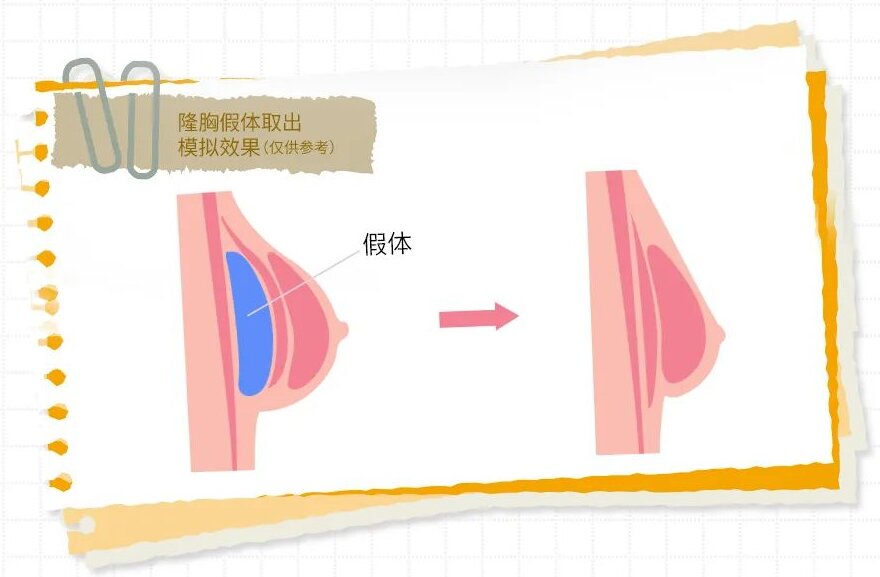 胸假体取出后能恢复原来样子吗