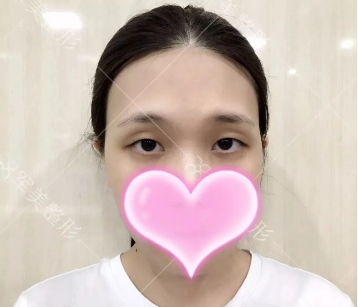 割双眼皮十个有九个后悔