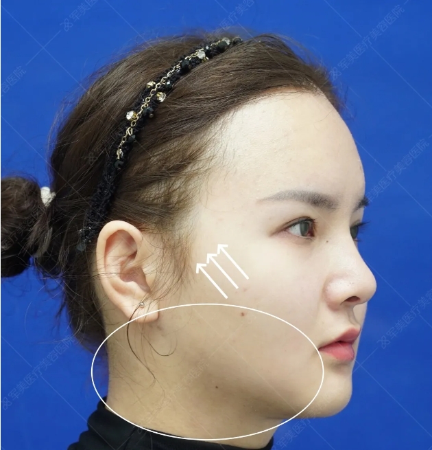 发腮如何改善
