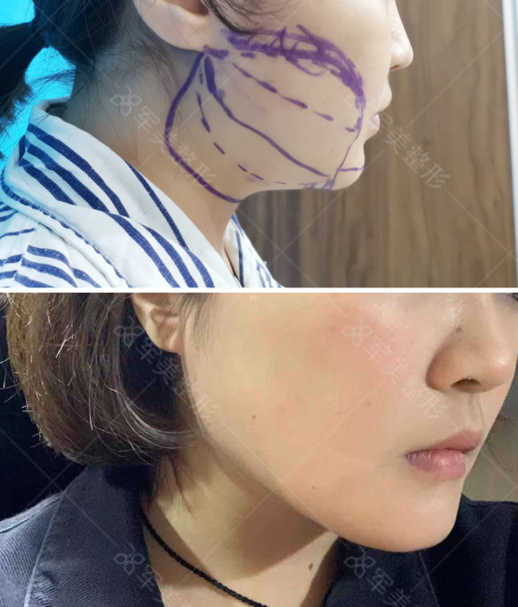 吸脂修复哪里最好