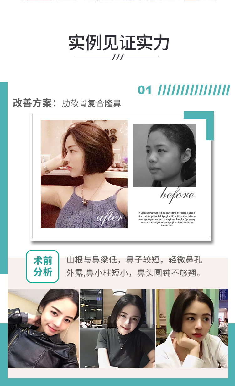 肋软骨隆鼻哪里好