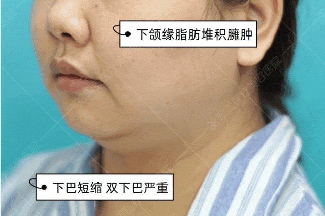 双下巴吸脂案例