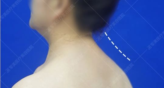 富贵包吸脂好还是手术切除好