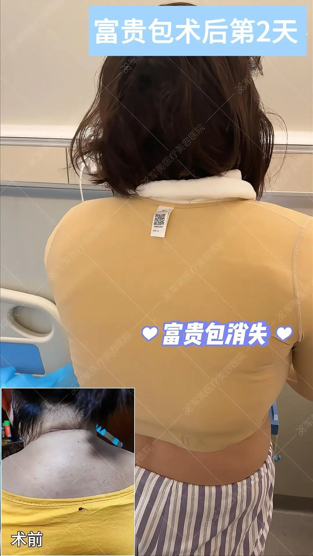 富贵包怎么消除最有效