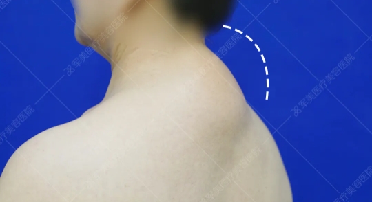 富贵包吸脂好还是手术切除好