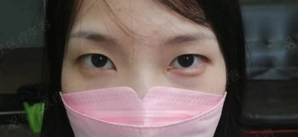 广州割双眼皮哪个医院好