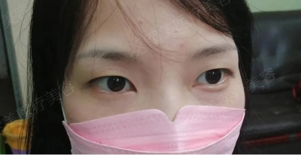 单眼皮变双眼皮案例