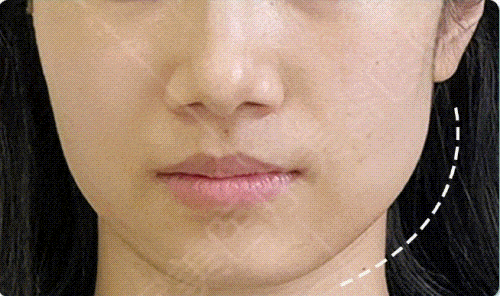 面部咬肌过大如何改善