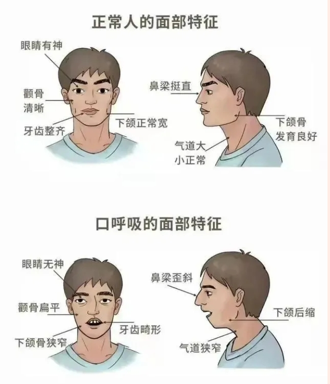 咬肌瘦脸针好不好