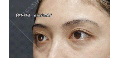 眼袋怎么去除最有效