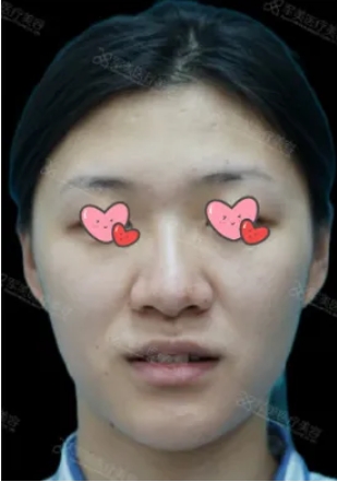 鼻头鼻翼缩小对比照