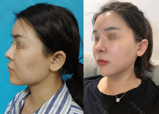 王世虎面部吸脂案例