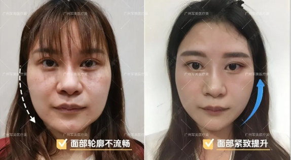 王世虎面部吸脂案例