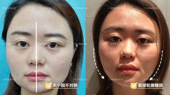 王世虎面部吸脂案例