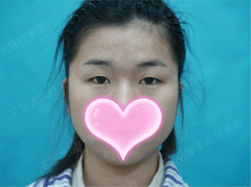 肿泡眼割双眼皮案例