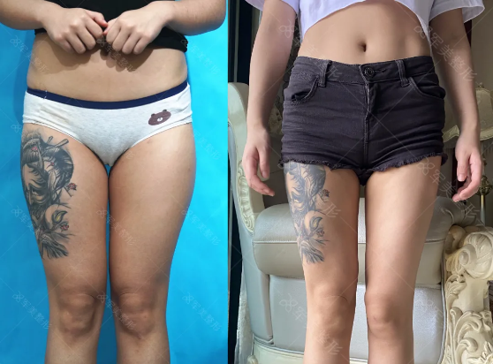 王世虎大腿吸脂案例