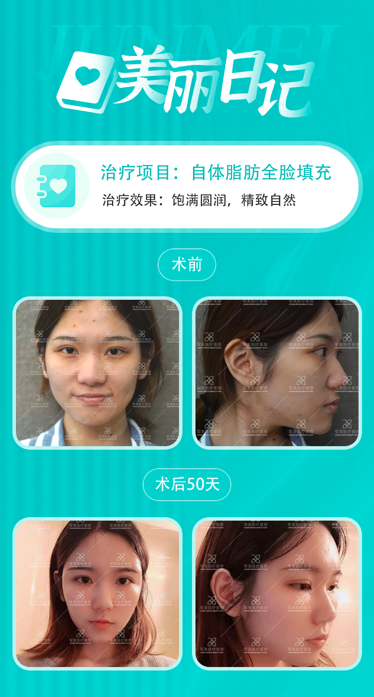 王世虎面部脂肪填充案例