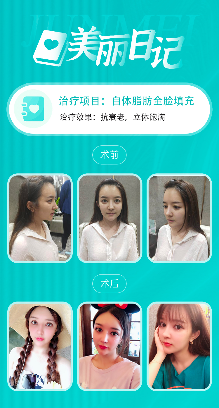 王世虎脂肪填充案例