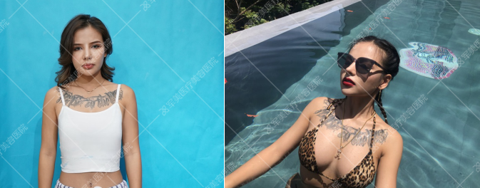 脂肪填充医生推荐