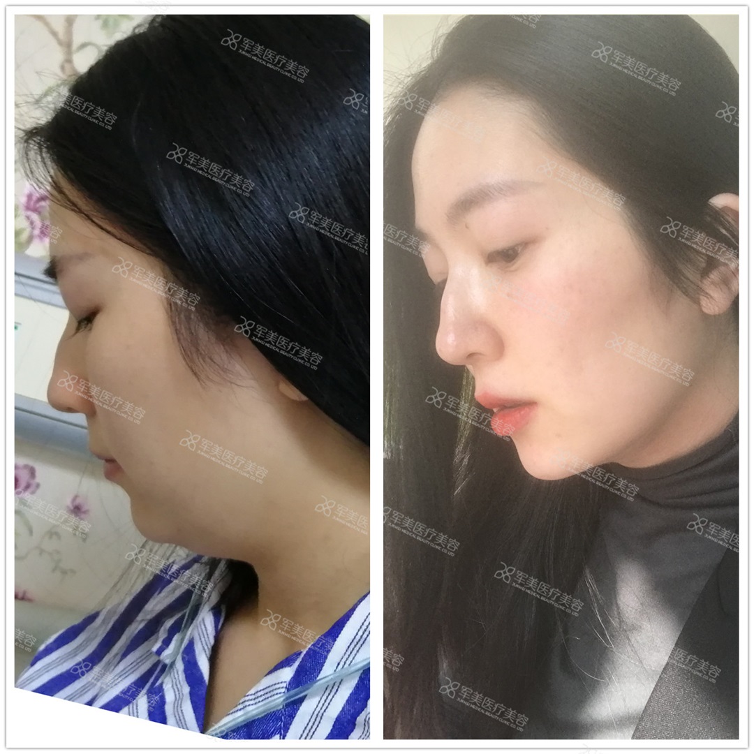 脸胖怎么瘦下来