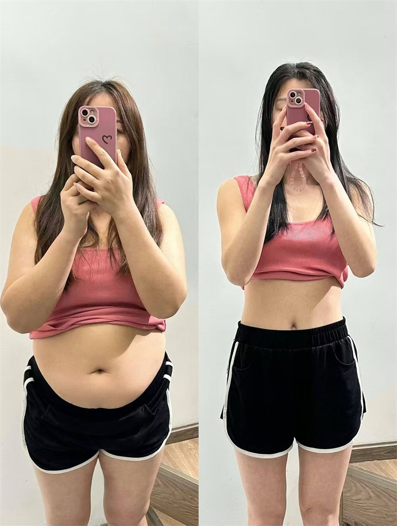 腰腹吸脂减肥案例