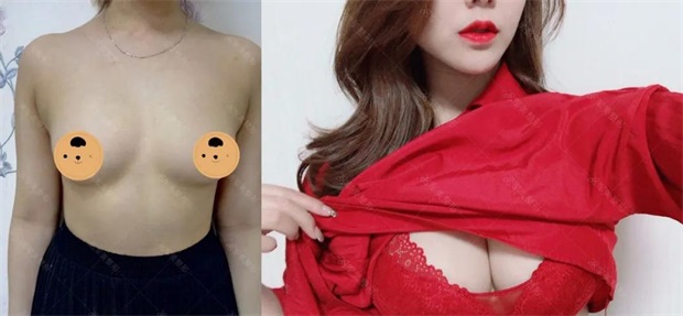 王世虎自体脂肪隆胸案例