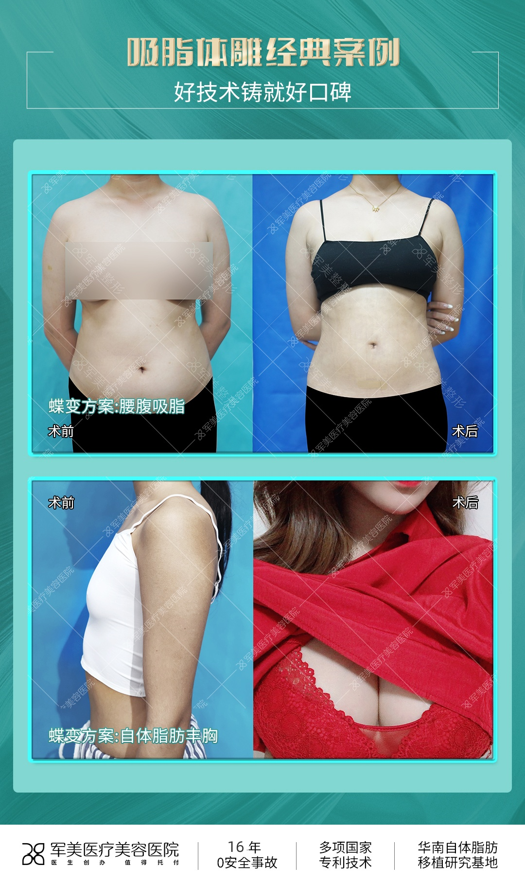 广州军美王娜脂肪填充案例
