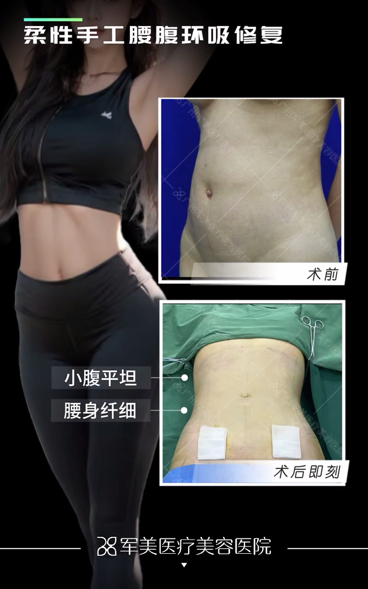 吴国勇腰腹吸脂修复案例