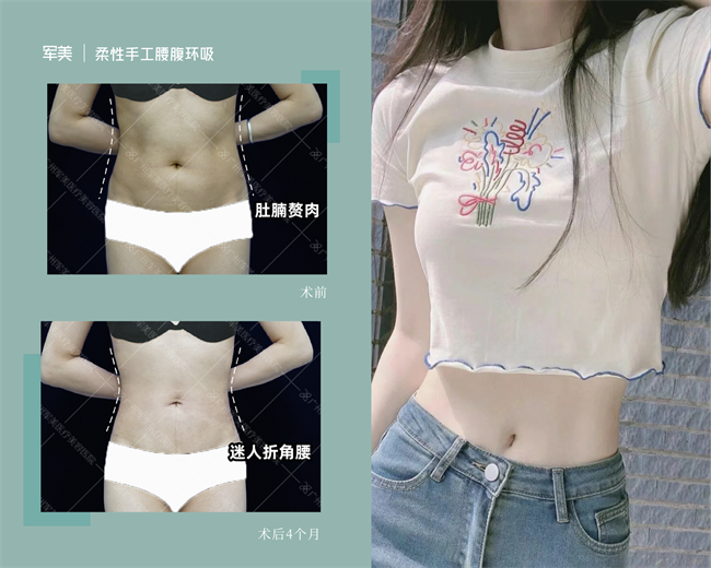 吴国勇腰腹环吸案例