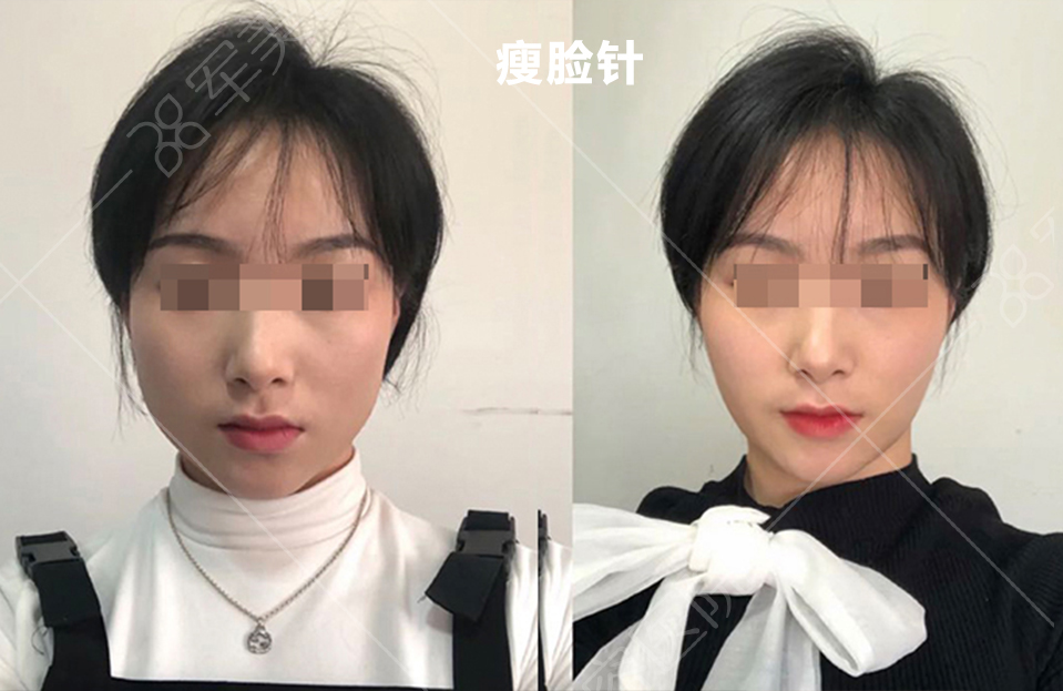 瘦脸针瘦脸案例