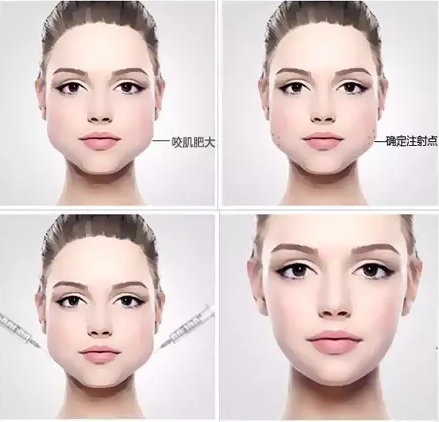 什么人适合打瘦脸针