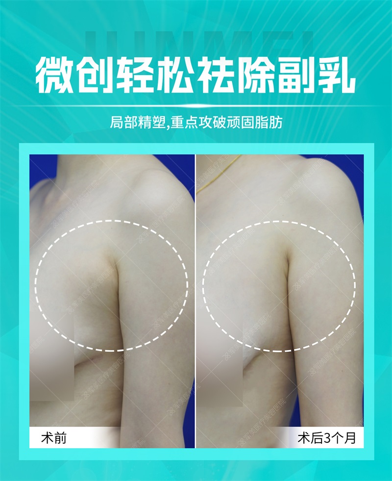 副乳怎样才可以消除