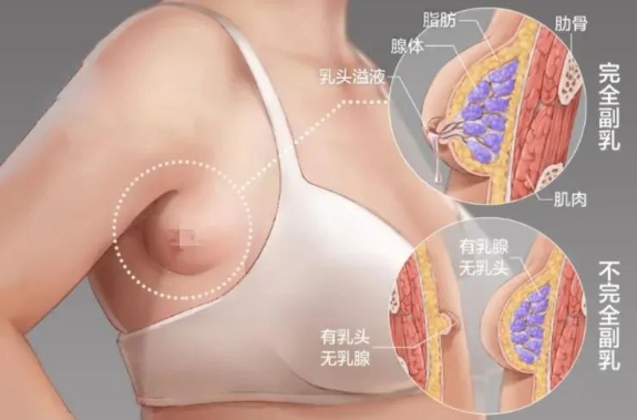 副乳是怎么来的