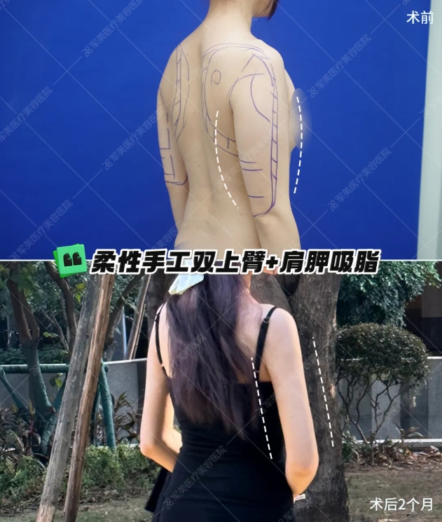 手臂脂肪多怎么瘦下来