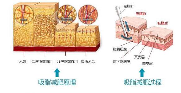 手臂脂肪多怎么瘦下来