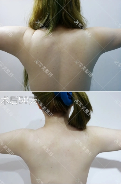背部吸脂手术效果图