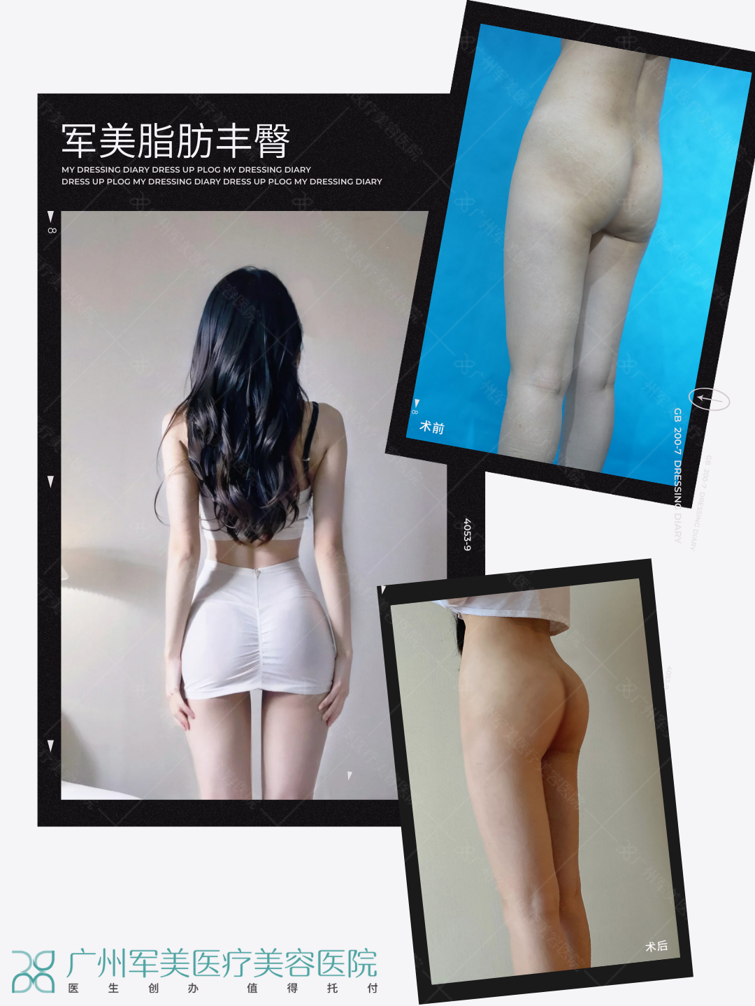 脂肪丰臀案例