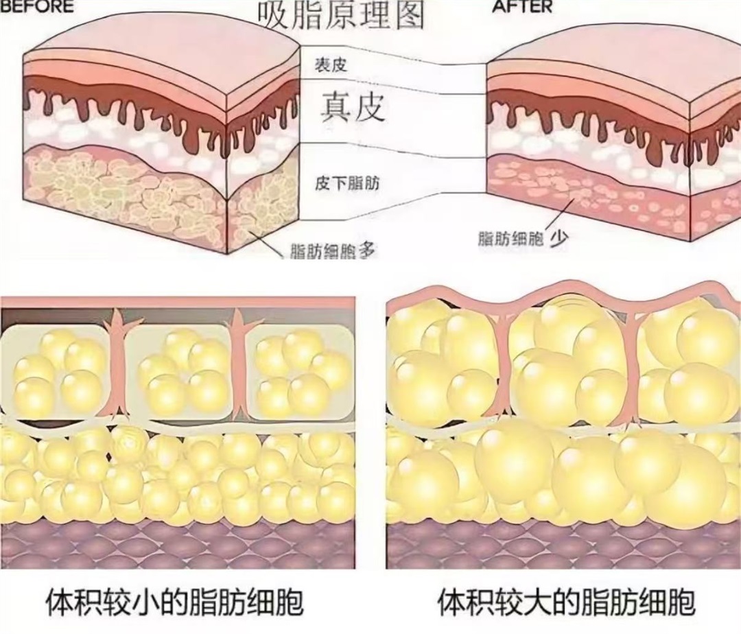 手臂吸脂