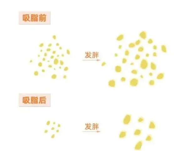 吸脂能瘦多少斤