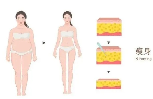 吸脂减肥瘦身