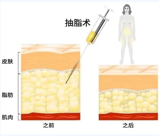 大腿吸脂术后护理注意事项
